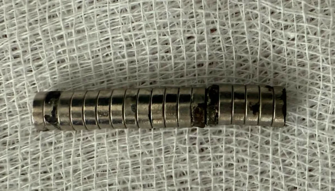 3 yaşındaki çocuğun yemek borusundan 19 mıknatıs çıkarıldı