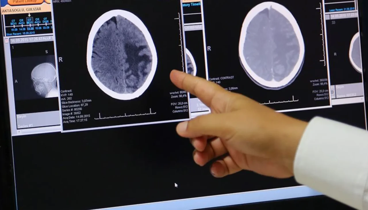 Baş ağrısı ve kusma beyin tümörünün ilk işareti olabilir