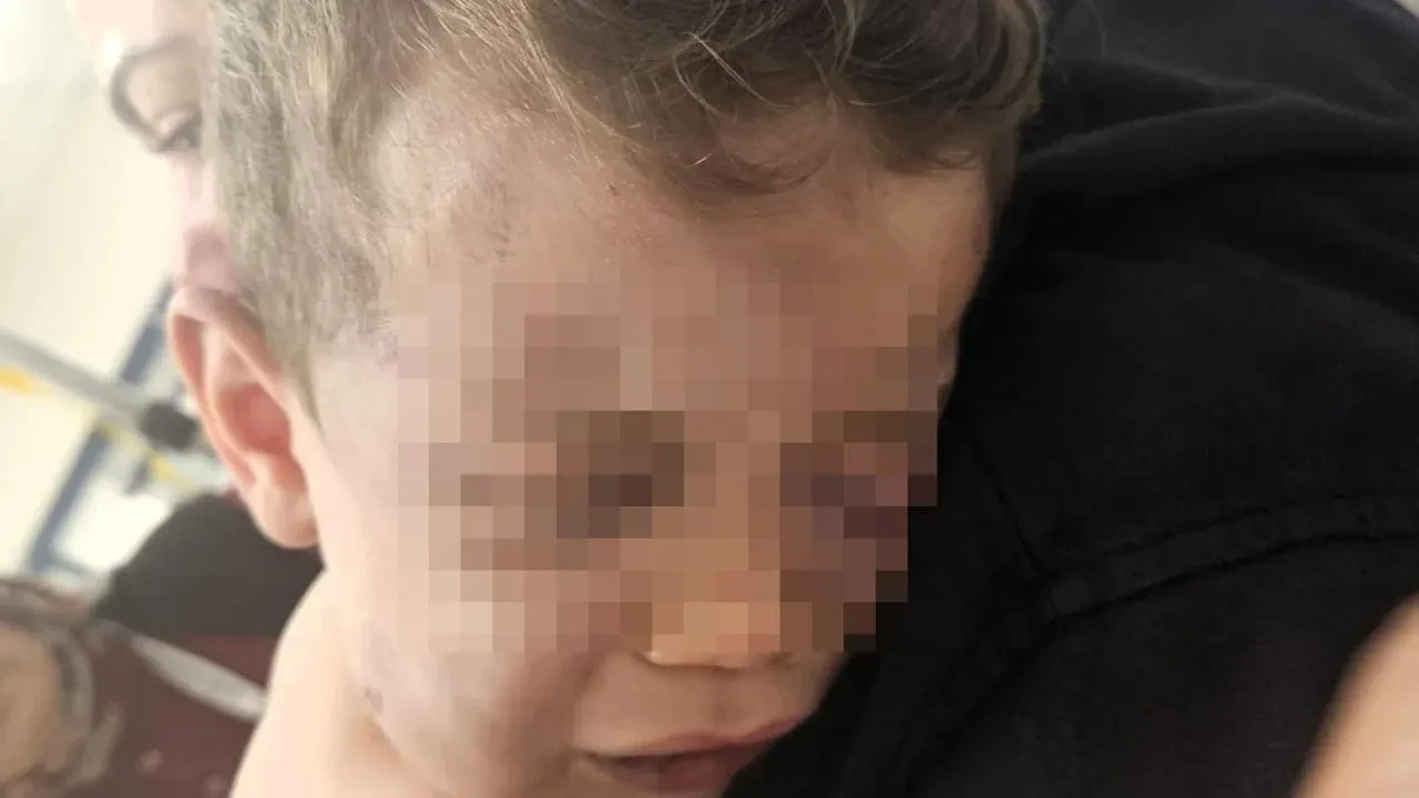 Denizli'de 2 Yaşındaki Bebek Darp Nedeniyle Hastaneye Yatırıldı; Sağlık Durumu Ciddiyetini Koruyor!