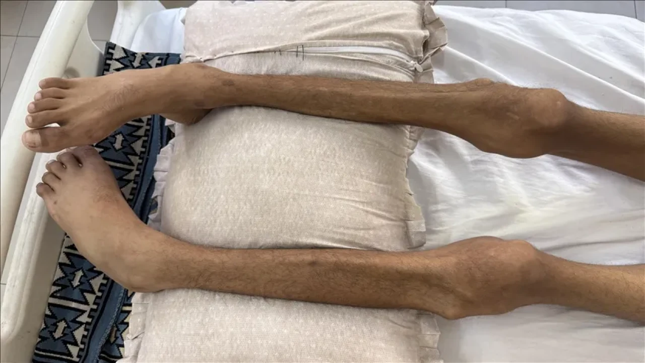 Gazze'de açlık ölümleri artıyor: Son 24 saatte 2 kişi daha hayatını kaybetti