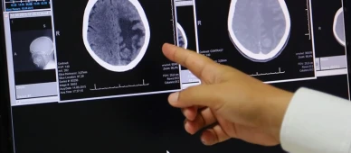 Baş ağrısı ve kusma beyin tümörünün ilk işareti olabilir