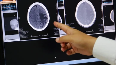 Baş ağrısı ve kusma beyin tümörünün ilk işareti olabilir