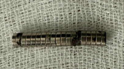 3 yaşındaki çocuğun yemek borusundan 19 mıknatıs çıkarıldı