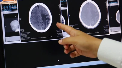 Baş ağrısı ve kusma beyin tümörünün ilk işareti olabilir